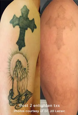 Eliminación de tatuajes en Pamplona (Iruña)