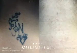 Eliminar tatuaje en Pamplona