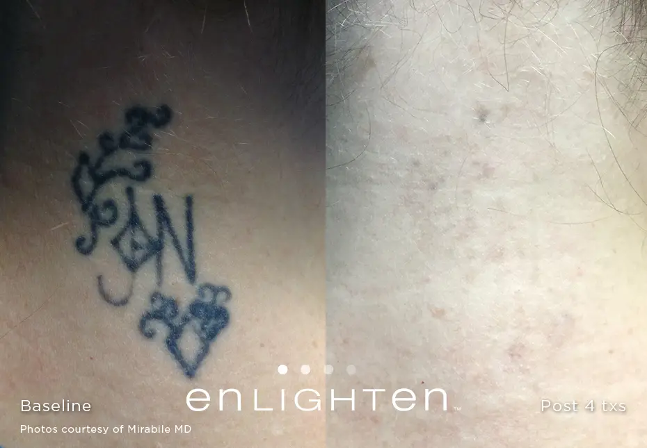 Eliminar tatuaje en Pamplona