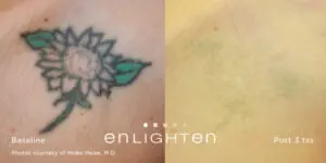 Eliminar tatuaje en Pamplona