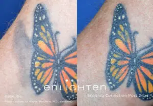 Eliminar tatuaje