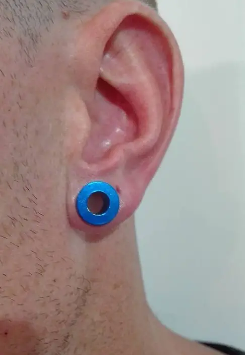 Dilatación en la oreja