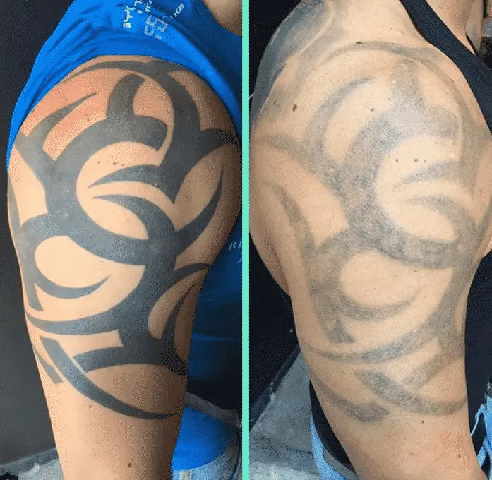 Eliminar tatuaje para Cover up, trabajo de Tattoo Adicts