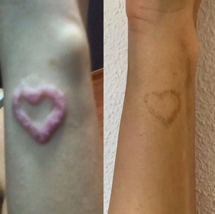 Eliminación tatuaje por alergia a la tinta