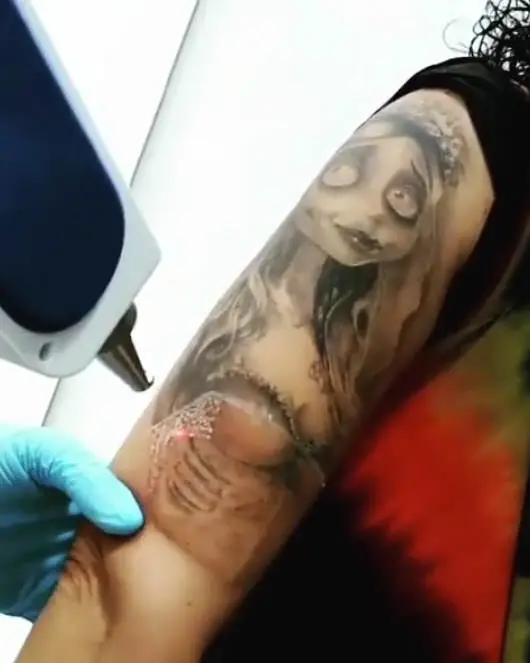 Segunda sesión eliminación de tatuaje en Granada