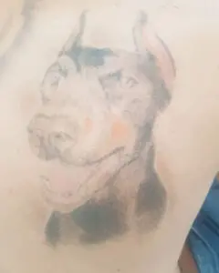 Primera sesión eliminación tattoo