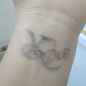 Eliminación de tatuaje