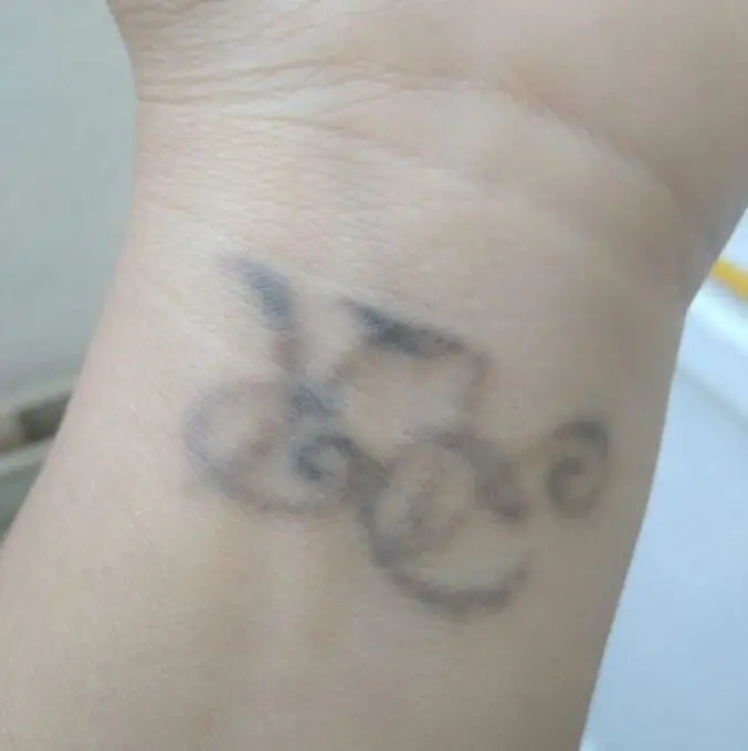 Eliminación de tatuaje