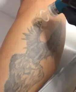 Eliminación de Tatuajes en Granada