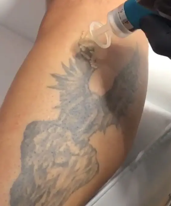 Eliminación de Tatuajes en Granada