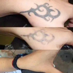 Eliminación tatuaje en la mano
