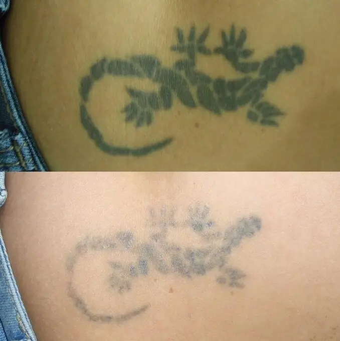 Eliminación tatuaje brazo